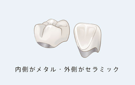内側がメタル・外側がセラミック