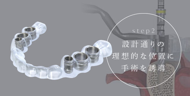 step2 設計通りの理想的な位置に手術を誘導