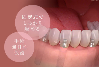 固定式でしっかり噛める/手術当日に仮歯